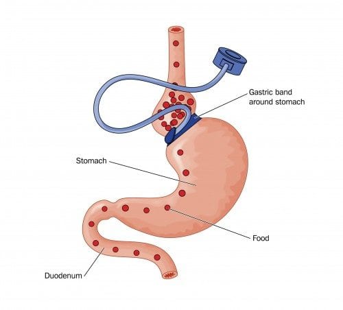 Gastric Banding In Mexico