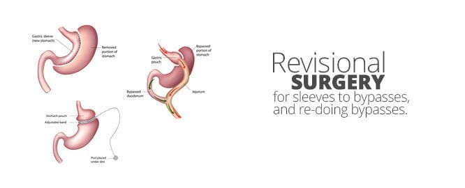 Bariatric Revision Surgery in Mexico