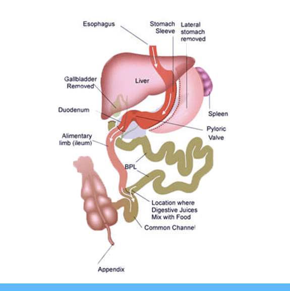 Post-Operative Diet Stages for Duodenal Switch (BPD/DS)