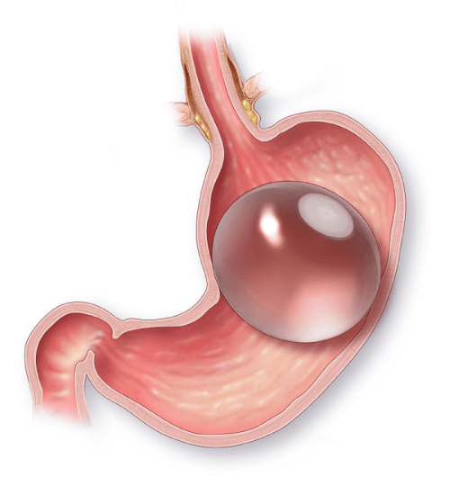 Gastric Balloon in Mexico