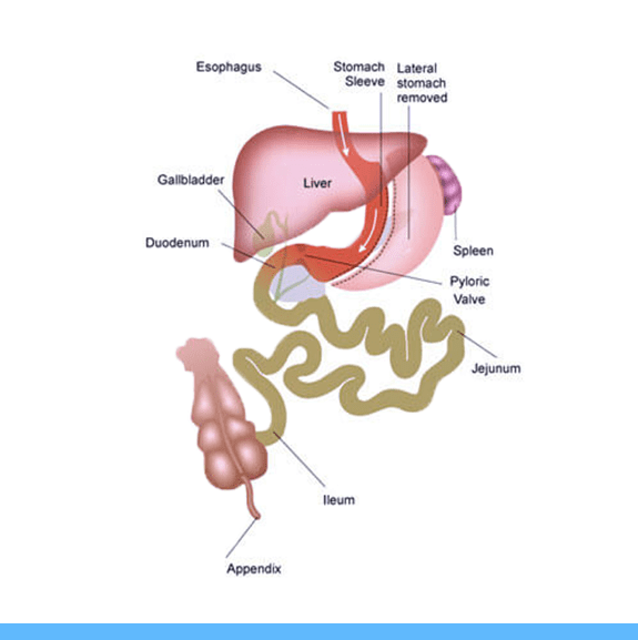 Gastric Sleeve in Mexico