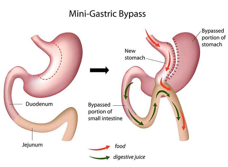 Mini Gastric Bypass in Mexico