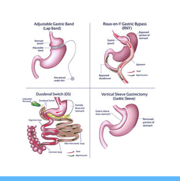 Gastric Bypass Surgery Revision - Tijuana, Mexico Resizing Stomach Pouch