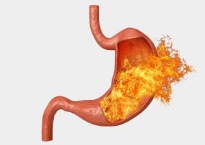 Tips to Avoid Acid Reflux