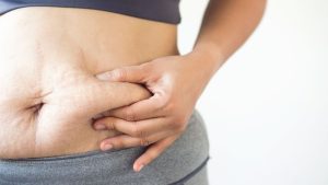 How Can You Quickly Eliminate Scars After Gastric Sleeve Surgery?