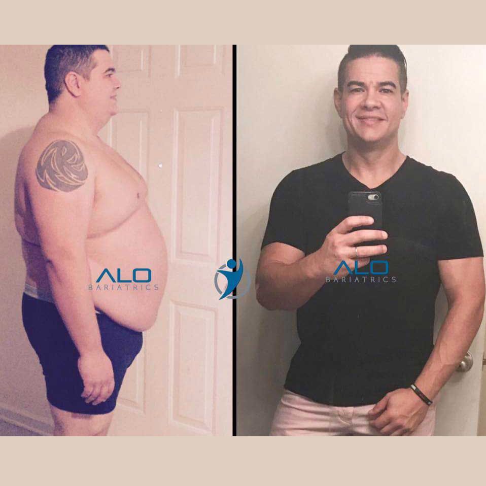 as before-and-after-bariatric-surgery-5