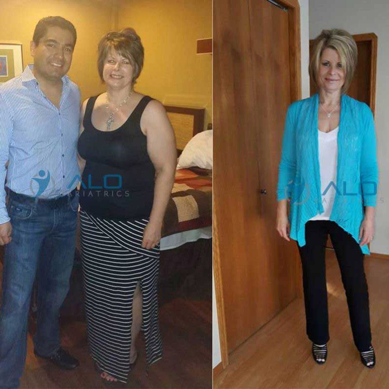 as before-and-after-bariatric-surgery-2