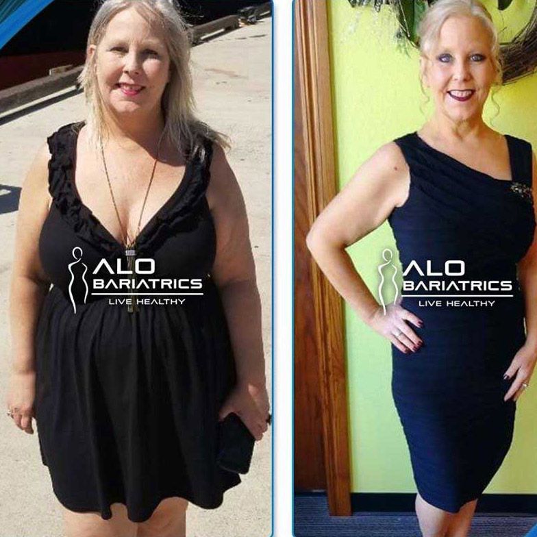 Before and After Gastric Bypass Surgery